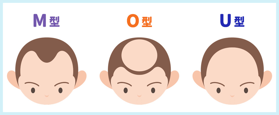 3つの禿げやすい場所の図解