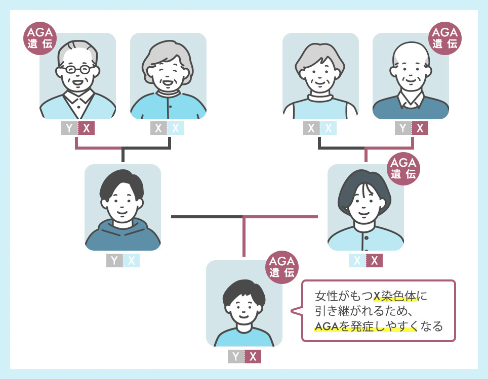 AGA遺伝は母方祖父が薄毛だと隔世遺伝しやすい
