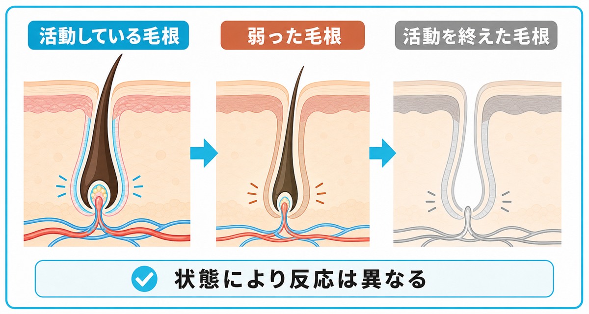 毛根が活動している状態から弱った状態を経て活動を終えた状態へ変わる段階を断面で示した図