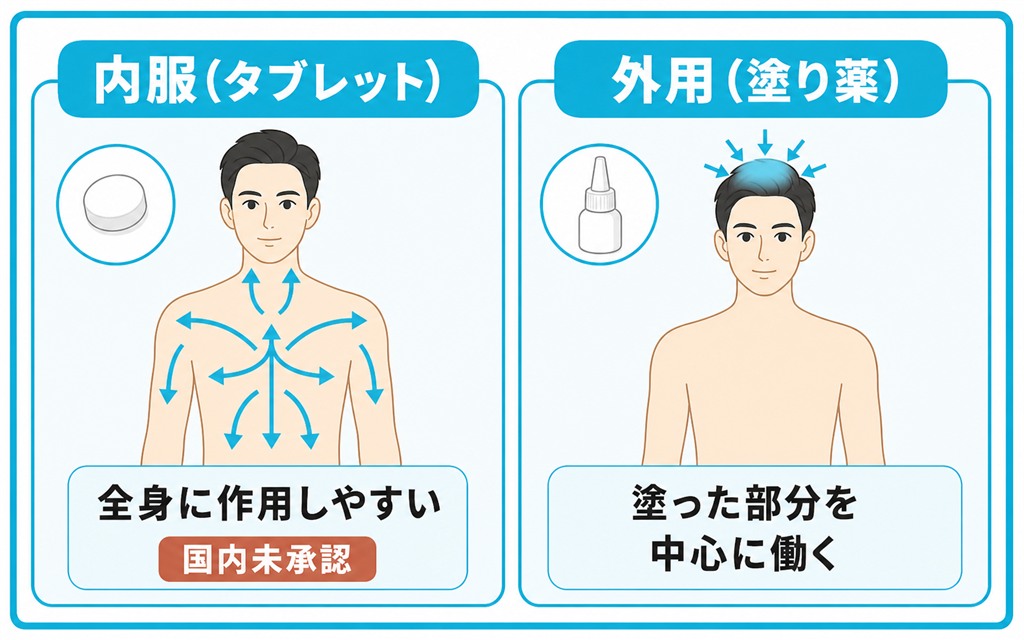 内服は成分が全身をめぐり外用は塗った部分を中心に働く、ミノキシジルの作用が届く範囲の違いを人物の図で対比した図