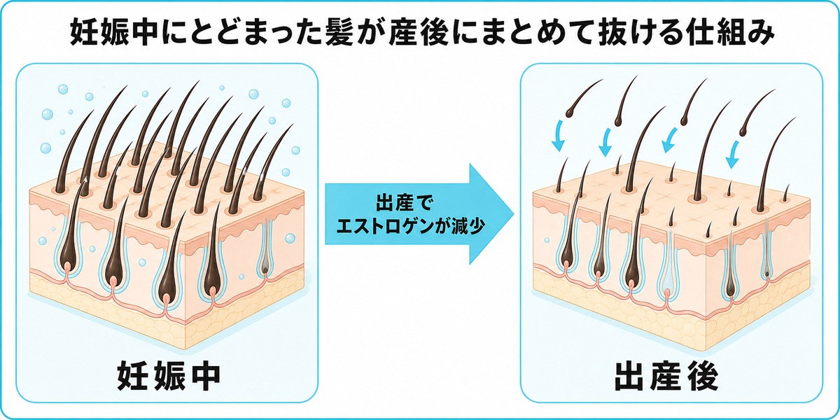 妊娠中にとどまっていた髪が出産後にまとめて休止期に入り抜けていく分娩後脱毛症の仕組みを示した図