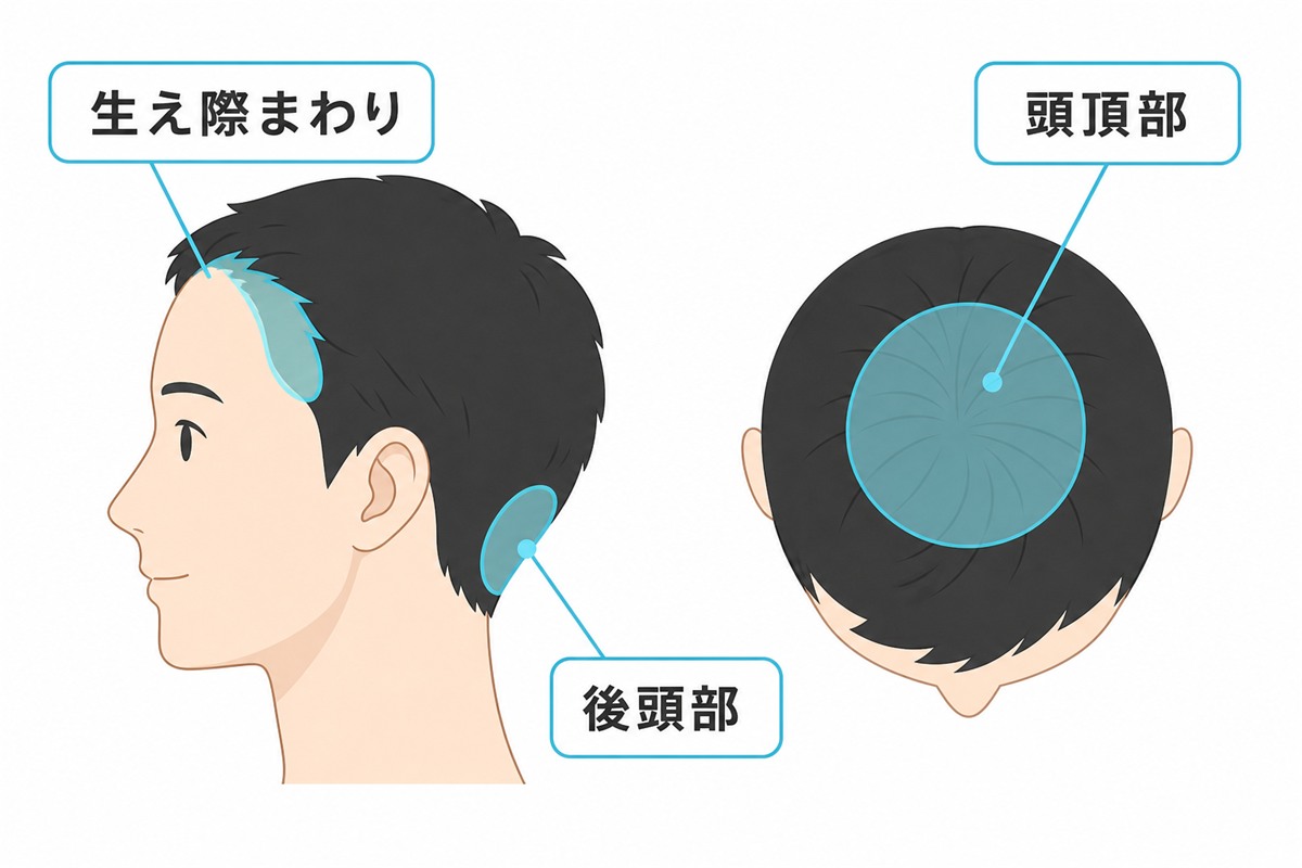 後頭部や頭頂部や生え際など頭皮ニキビができやすい位置を示した部位図