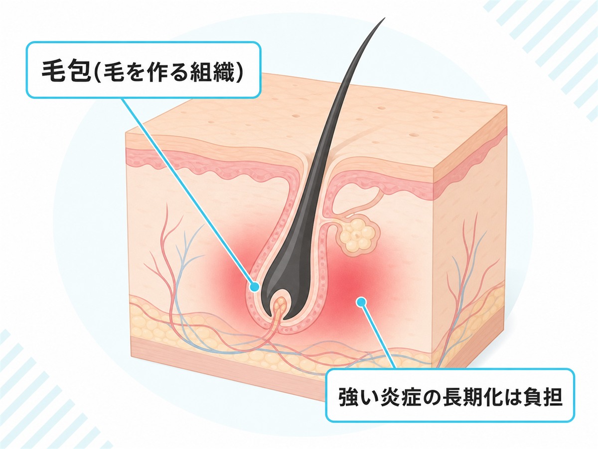 毛包の断面と強い炎症が長引くと毛包の環境に影響しうることを示した解剖図