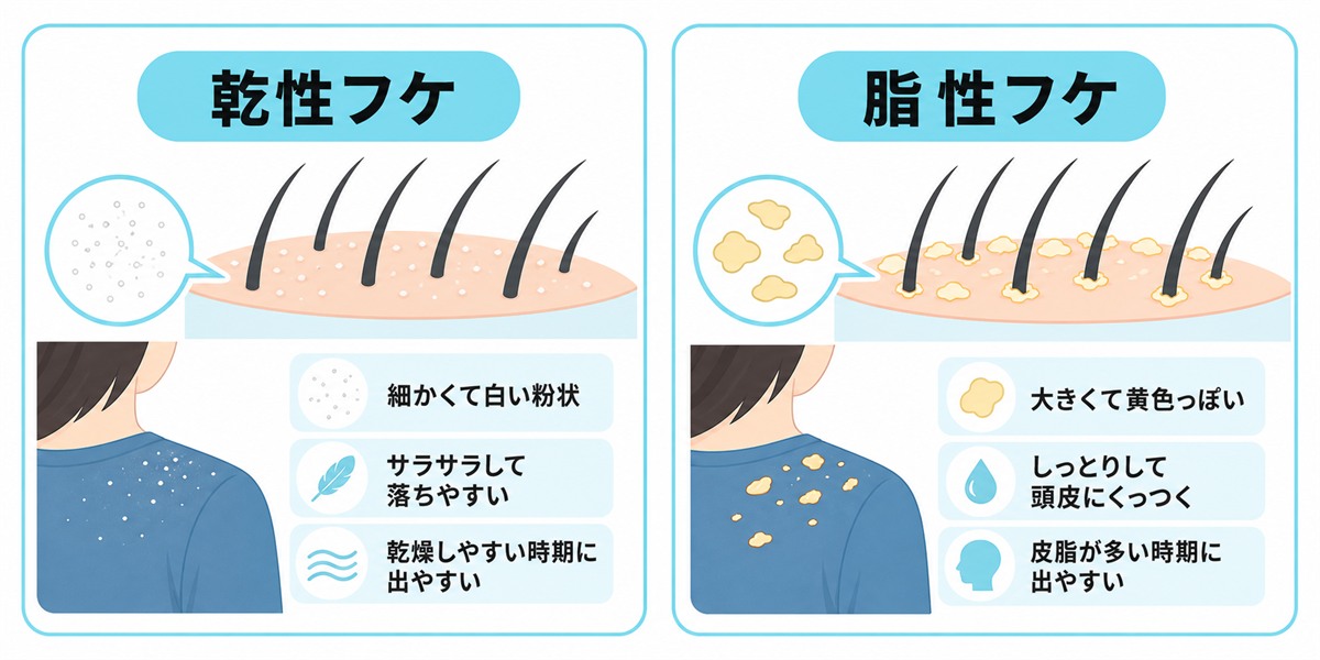 乾性フケは白く細かくパラパラと落ち脂性フケは黄色くべたつくという見た目の違いを示したイラスト