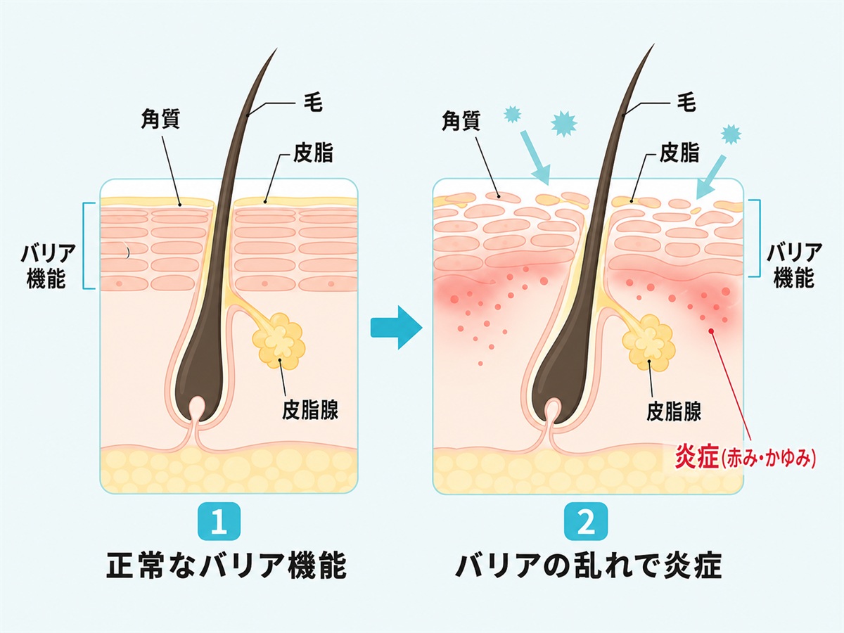 頭皮の皮膚の断面と皮脂やバリア機能の乱れが炎症につながる頭皮湿疹の仕組みを示した図