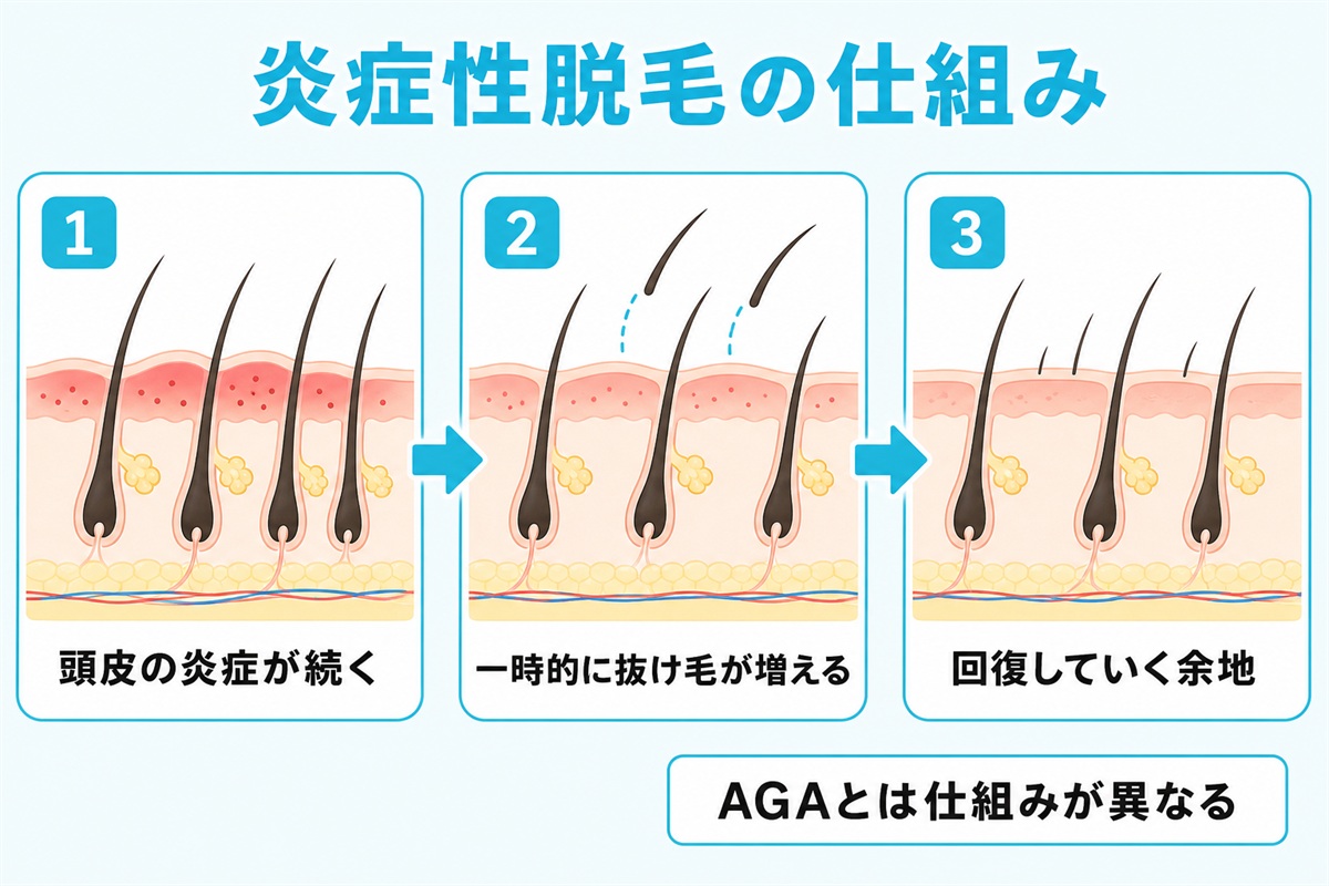 頭皮の炎症で一時的に抜け毛が起こり回復する炎症性脱毛の仕組みとヘアサイクルを示した図