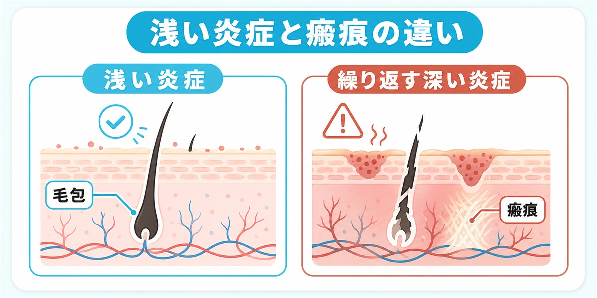 浅い毛嚢炎は毛包が残り回復し繰り返す深い炎症は毛包が壊れて瘢痕性脱毛になるしくみを対比した図解