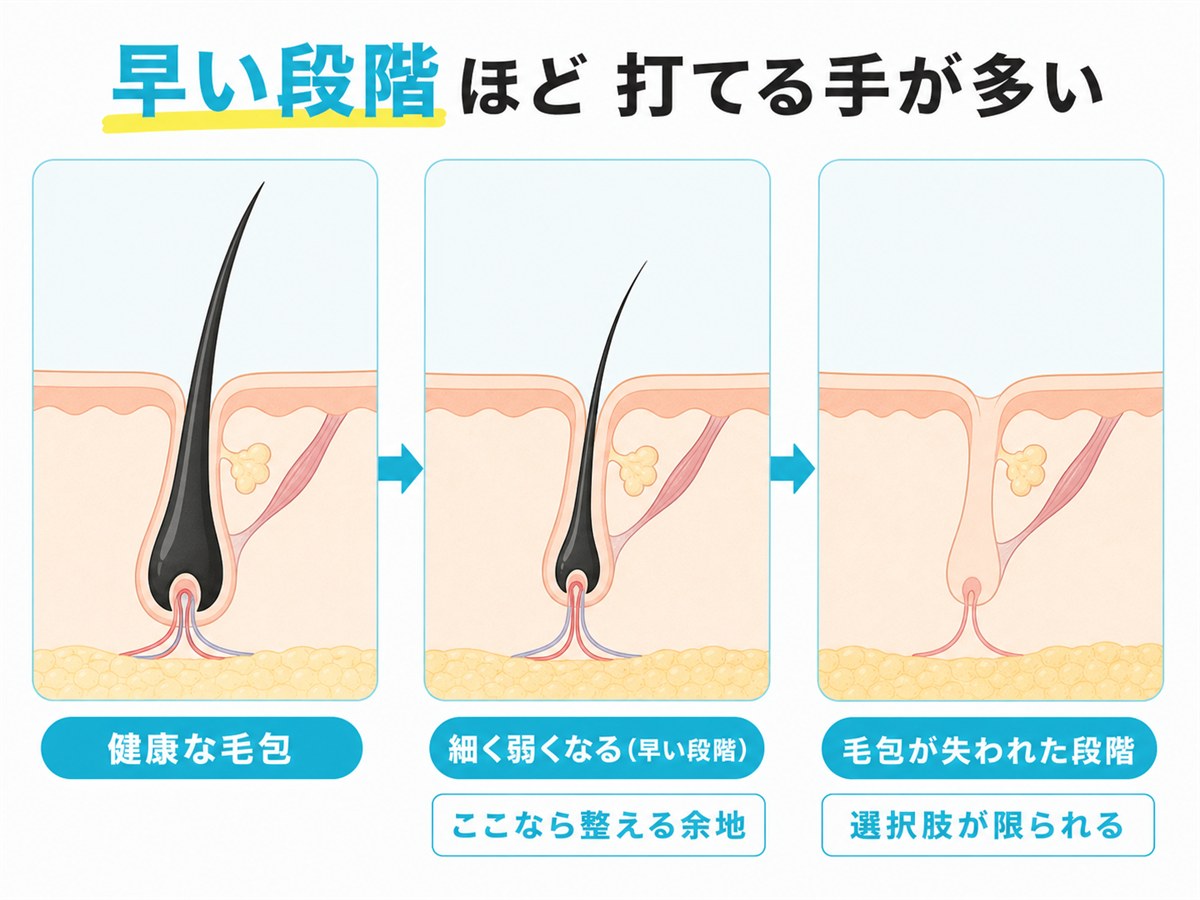 毛包が健康な状態から弱り失われるまでの段階を示す断面の図解