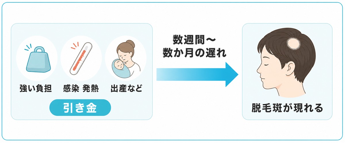 強い負担から数週間から数か月の遅れをへて脱毛が現れる円形脱毛症のタイムライン図